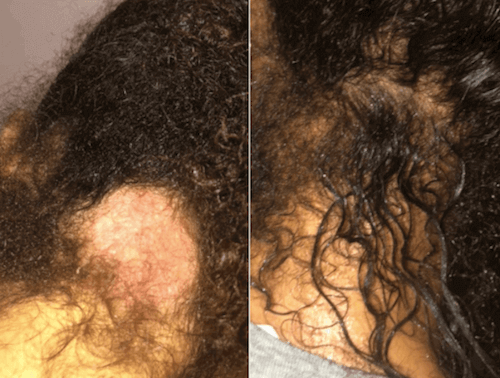 Mum's struggle with psoriasis inspires natural products for black hair -  Voice Online